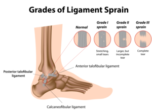 ankle sprain treatment