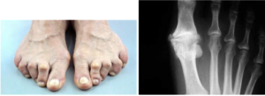 arthritis affecting feet