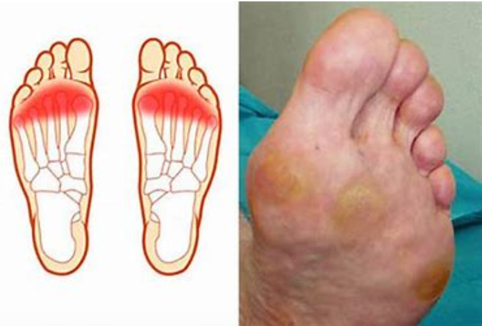Metatarsalgia-podiatry-of-arlington-heights.webp